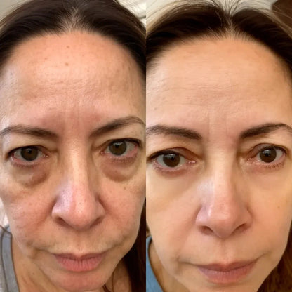 RevitalEyes® 2-w-1 Terapia Czerwonym Światłem + EMS na redukcję worków pod oczami